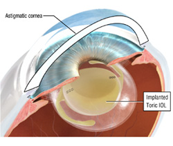 Astigmatism Surgery and Astigmatism Correction