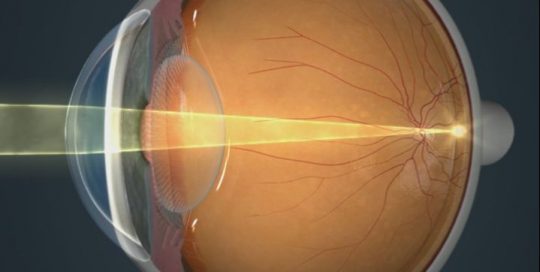 What is a refractive error?