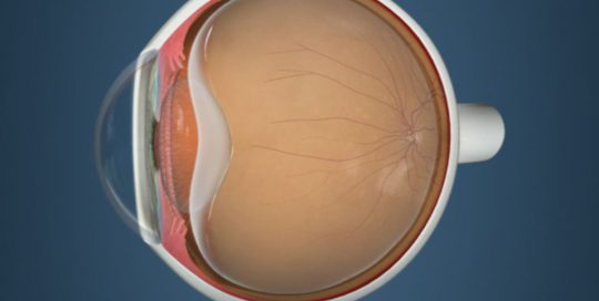 vitreous detachment