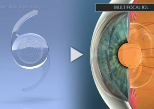 IOL Multifocal Introduction