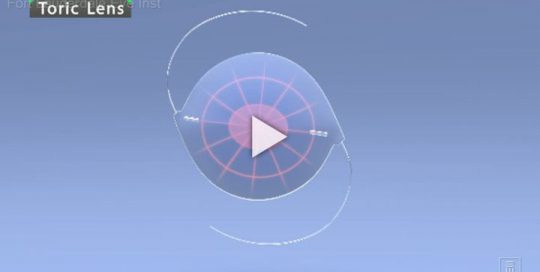 IOLToric Lense Overview